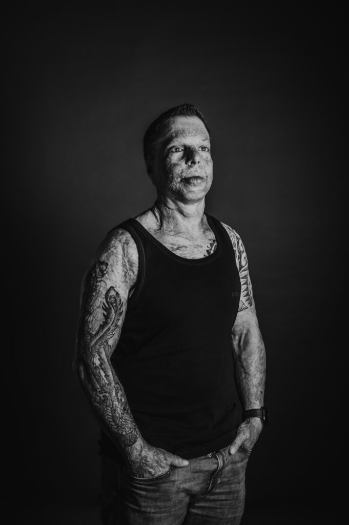 Schwarzweiß Portrait von einem Mann mit Verbrennungen